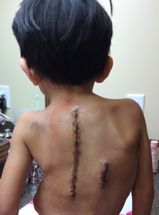 Bandages removed this morning